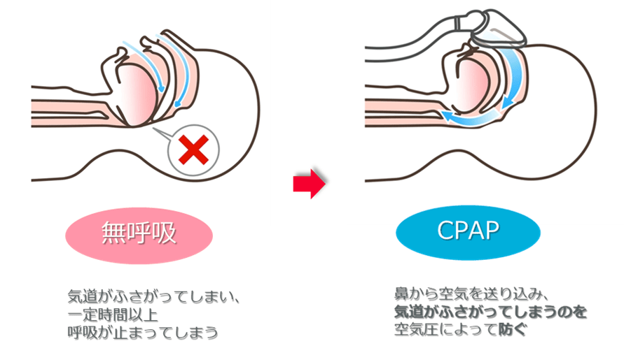 CPAP療法について